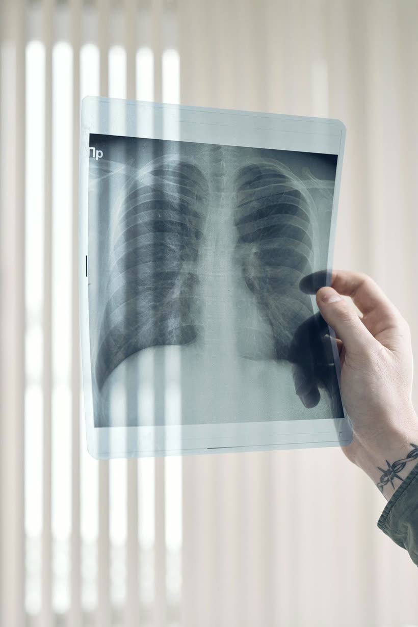 Radiografia del torace osservata in controluce